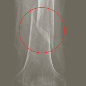 Osteoporosa